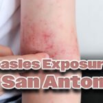 1740504675 Measles Sa.jpg